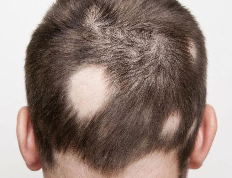 alopesi.jpg